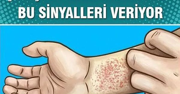Böbreklerinizin düzgün çalışmadığını gösteren belirtiler 