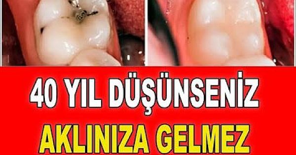 Çürük dişleri eski haline çeviriyor! 