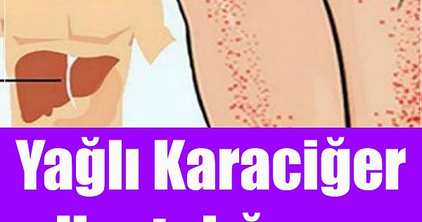 Yağlı Karaciğer Hastalığının 10 Belirtisi 