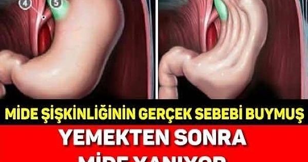 Yemeklerden sonra yaşanan şişkinlik, gaz ve mide yanması 