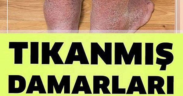 Tıkalı Tüm Damarları Açıyor 