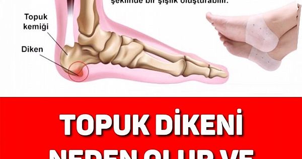TOPUK DİKENİ NEDEN OLUR 