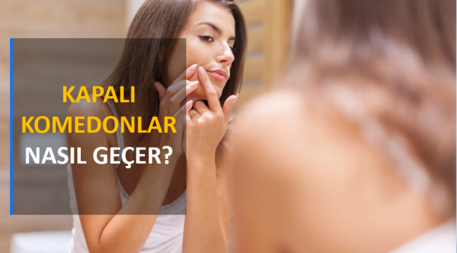 Kapalı Komedonlar Nasıl Geçer?