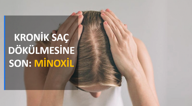 Kronik Saç Dökülmesine Son: Minoxil